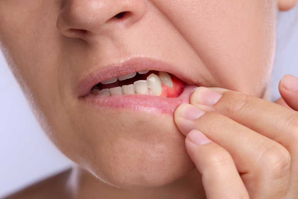 Woman with inflamed gums, touching her cheek with fingers, showing teeth.