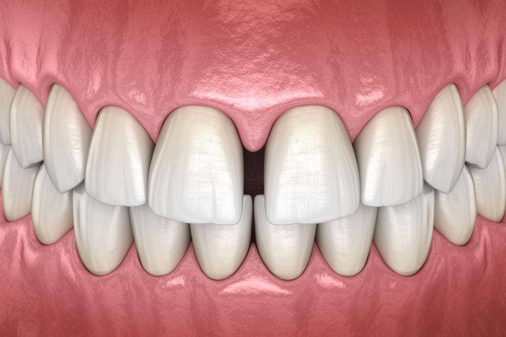 Close-up of teeth with a noticeable gap between the two front teeth; pink gums are visible.